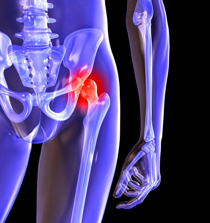 Cacad arthosis hip
