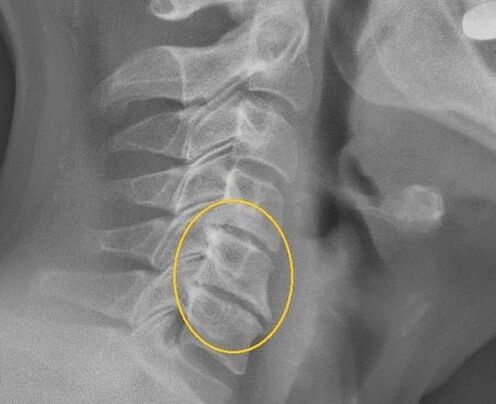 Osteochondricosis tulang tonggong cervical dina x -ray