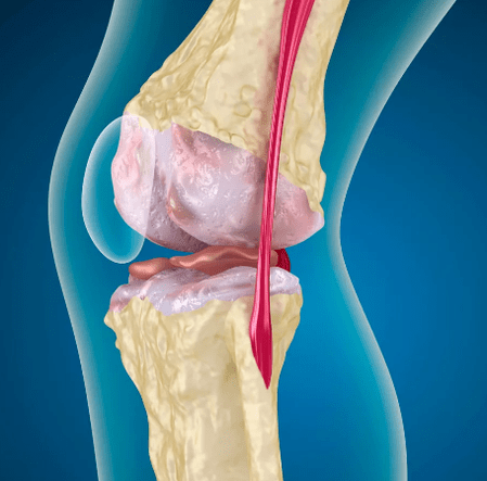Arthrososis gabungan dengkul