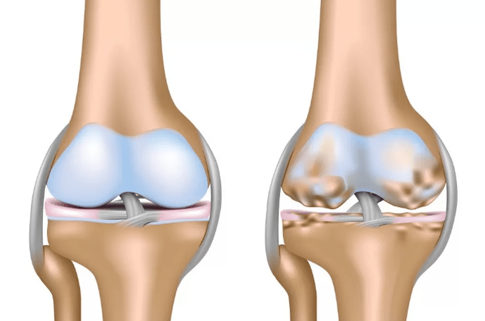 Cacad arthrosis tina gabungan dengkul