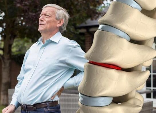 Osteochondrosis mangaruhan cakram intervertebral sareng nyababkeun nyeri deui