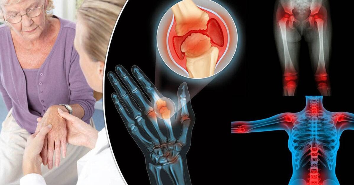 naon arthrosis